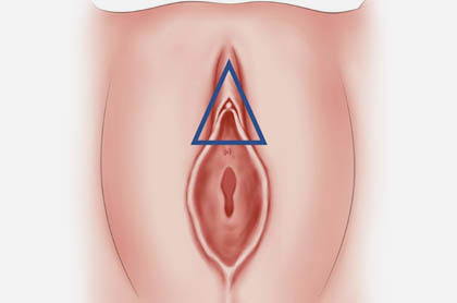 Clitoral Hood Reduction surgery Ghaziabad