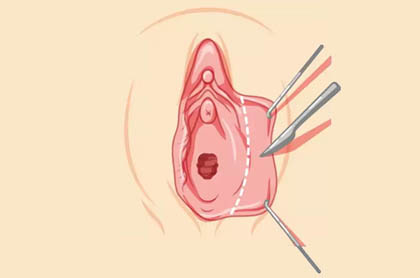 Labia Majora Plasty surgery Ghaziabad