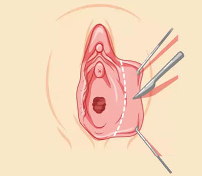 Labia Majora Plasty Hospital Ghaziabad