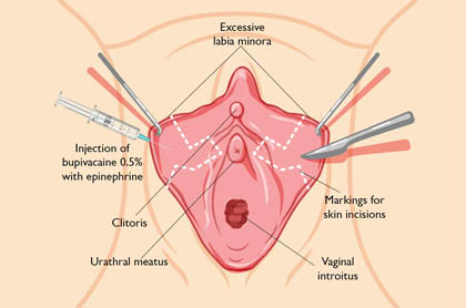 Labia Minora Plasty surgery Ghaziabad