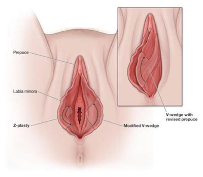 Labia Minora Plasty surgery Hospital Ghaziabad