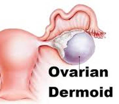 Dermoid Cysts treatment and surgery Hospital Ghaziabad