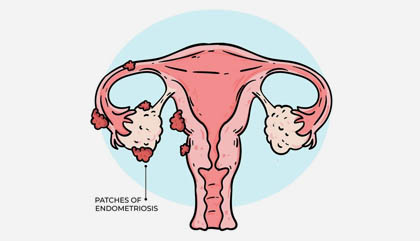 Endometriosis treatment and surgery