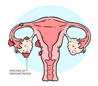 Endometriosis treatment and surgery Hospital Ghaziabad