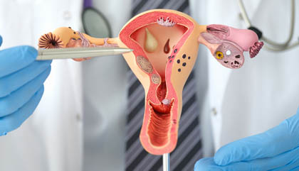 Ovarian Cysts treatment and surgery