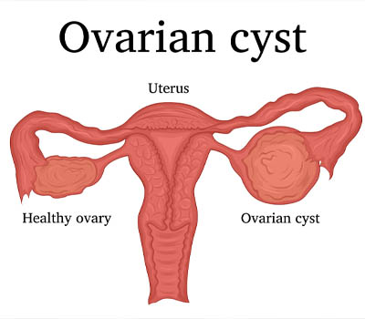 Ovarian Cysts treatment and surgery Hospital Ghaziabad