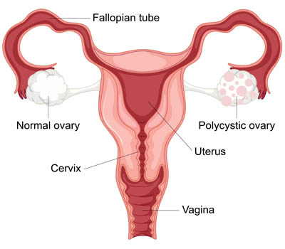 PCOS and Hyperprolactinemia treatment Hospital Ghaziabad