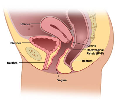 Recto-vaginal treatment and surgery Hospital Ghaziabad