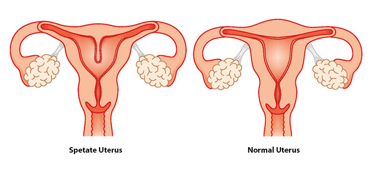 Septate Uterus treatment in Ghaziabad