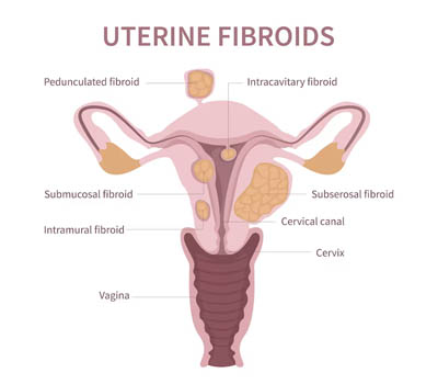 Uterine Fibroids treatment and surgery hospital Ghaziabad