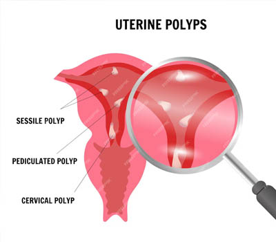 Uterine polyps treatment hospital Ghaziabad