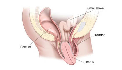 Uterine Prolapse treatment and surgery Ghaziabad