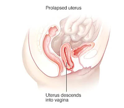 Uterine Prolapse treatment and surgery Hospital Ghaziabad