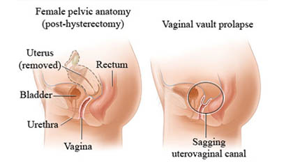 Vault Prolapse treatment and surgery Ghaziabad