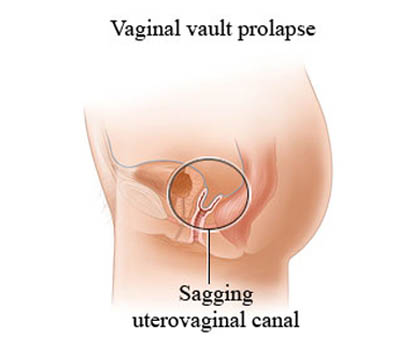 Vault Prolapse treatment and surgery Hospital Ghaziabad