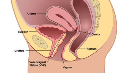 Vesico - vaginal fistula treatment and surgery Ghaziabad