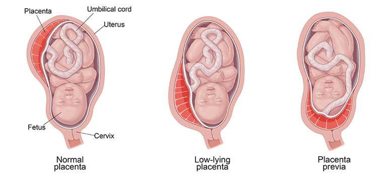 Placenta previa treatment Ghaziabad